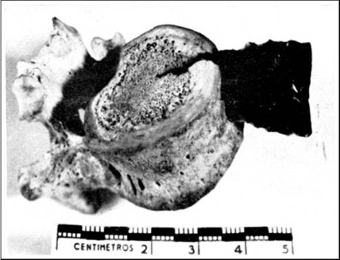 An obsidian point embedded in a human lumbar vertebra that apparently entered through the stomach (from Ravines 1967: 230).